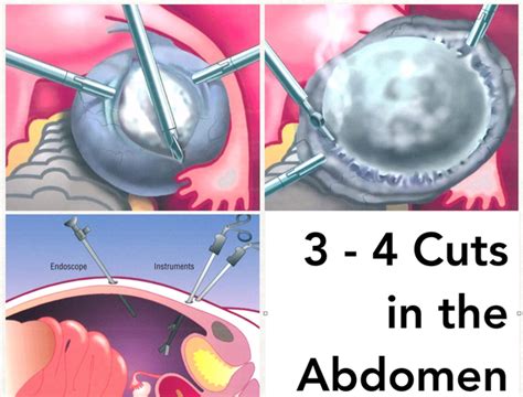 ovarian cyst biopsy procedure|ovarian cysts when to worry.
